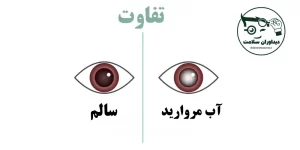 آب مروارید