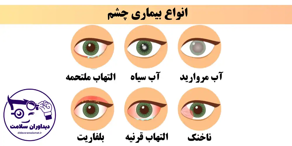 انواع بیماری های چشمی