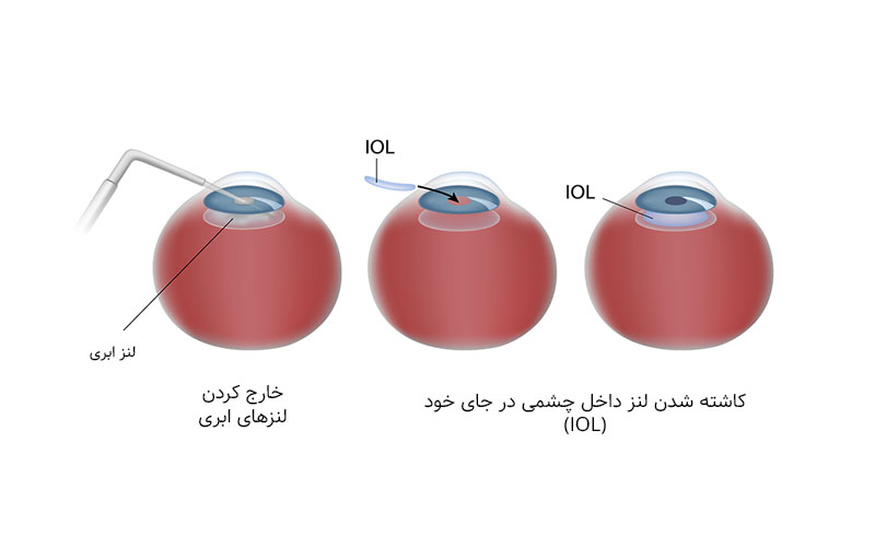 هزینه عمل آب مروارید بدون بیمه: راهنمای کامل و جامع برای دید بهتر