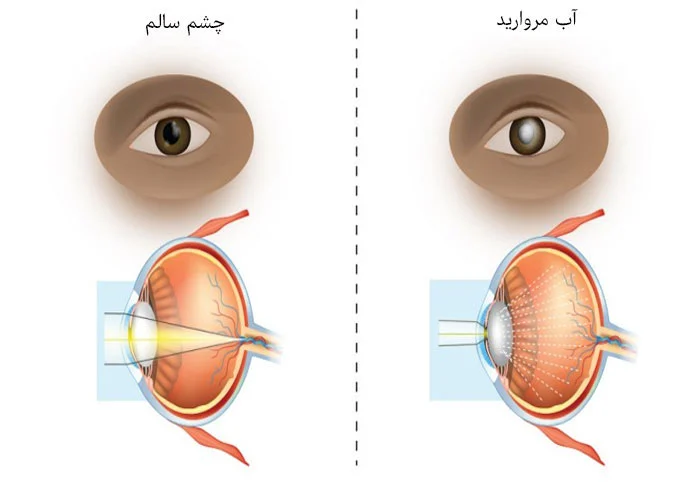 تشخیص آب مروارید