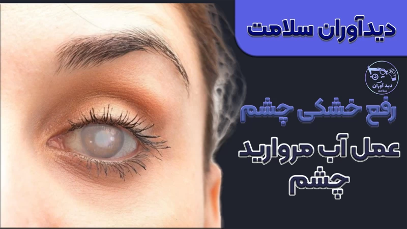 عمل آب مروارید در کلینیک چشم پزشکی دیدآوران