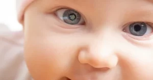 آب مروارید مادرزادی در نوزادان