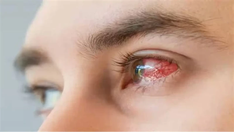 پیشگیری از به وجود آمدن سوزش چشم