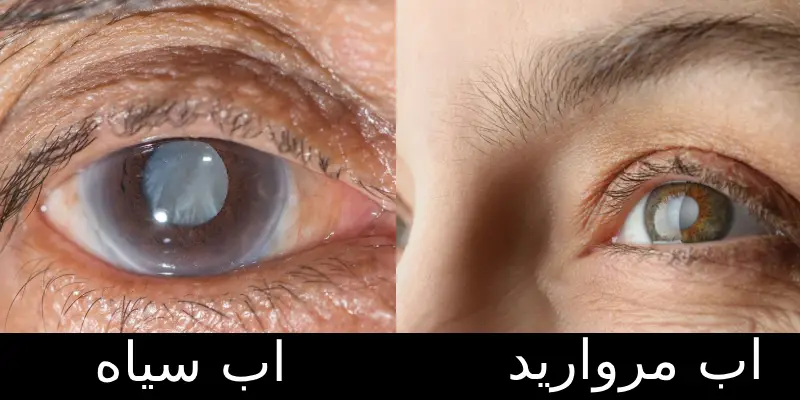 تفاوت آب سیاه و آب مروارید