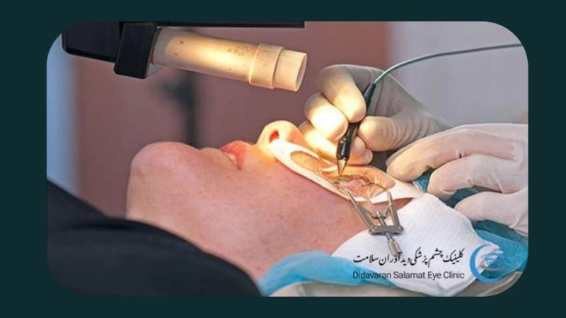 تعرفه هزینه عمل لیزیک چشم